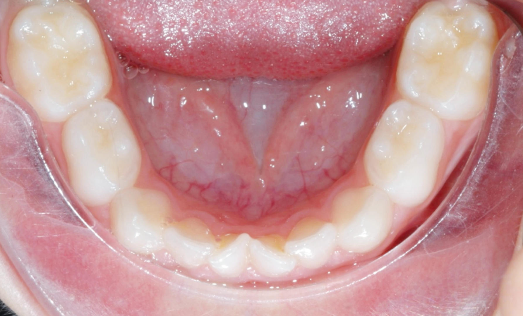 Fig. 1 CDD affollamento in dentatura decidua.