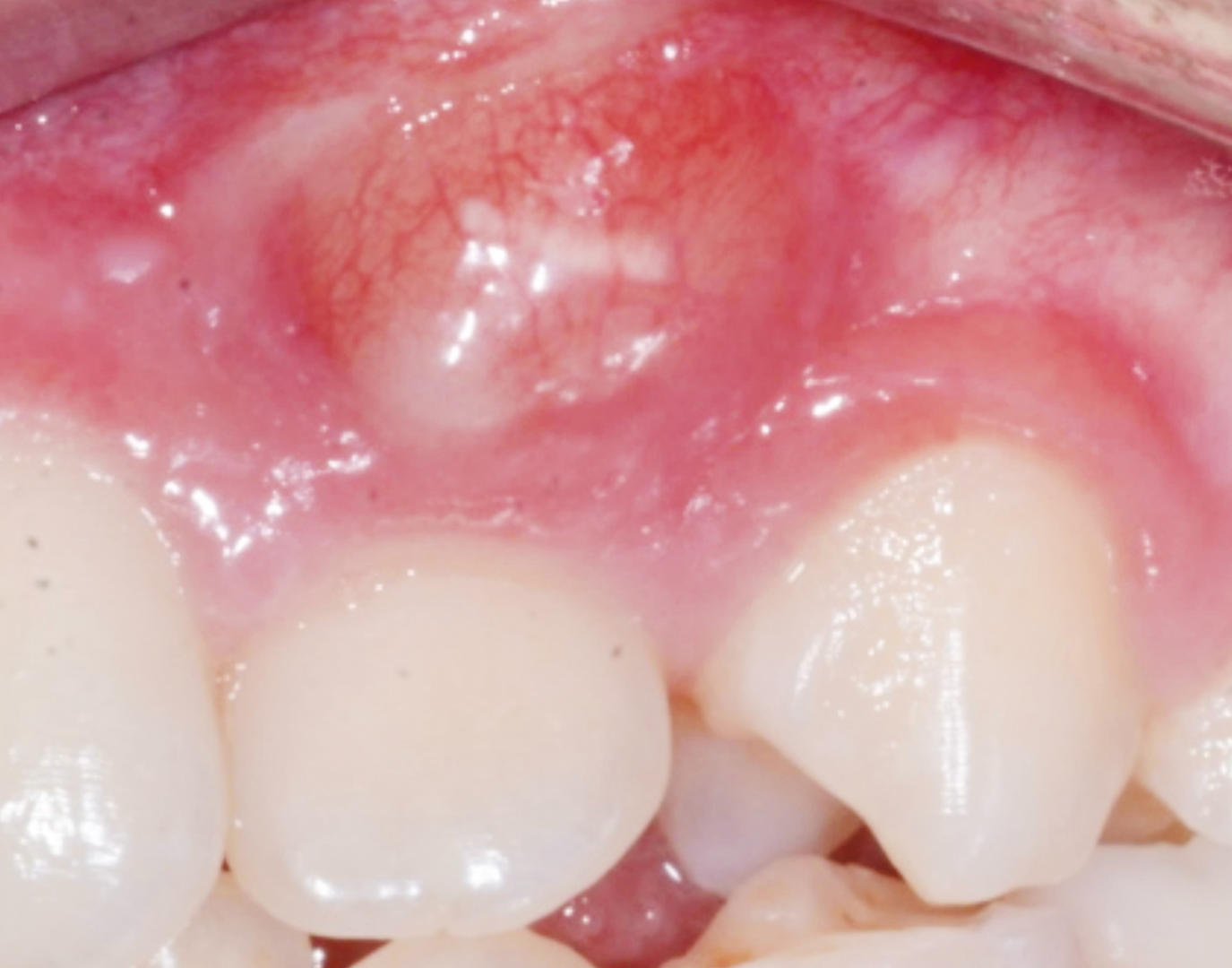 Fig. 8 CBM canino sporgente nella maxilla.