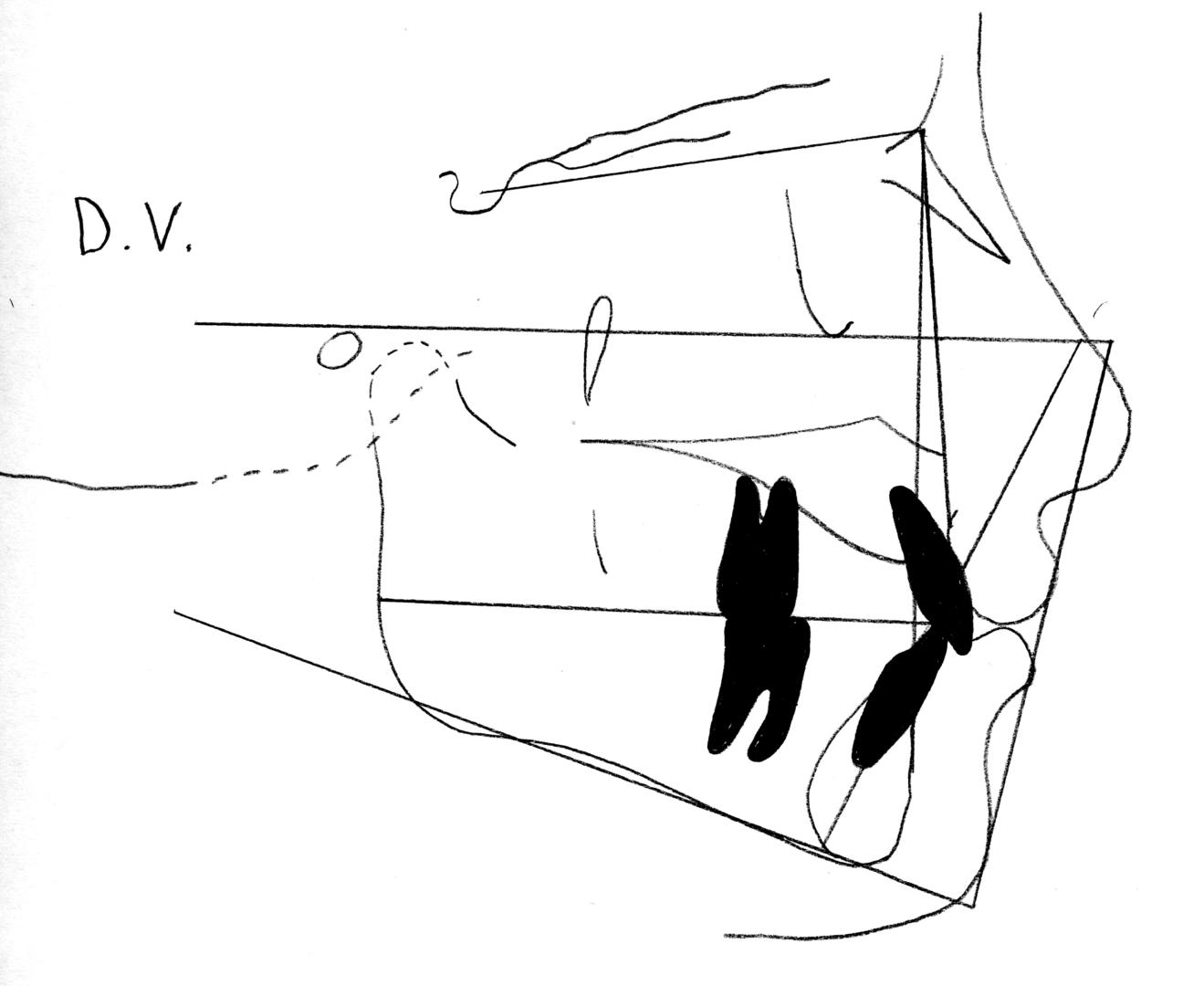 Fig. 16b Tracciato cefalometrico.