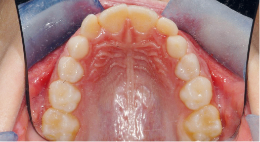 Fig. 1c Fotografia intraorale iniziale del primo paziente.