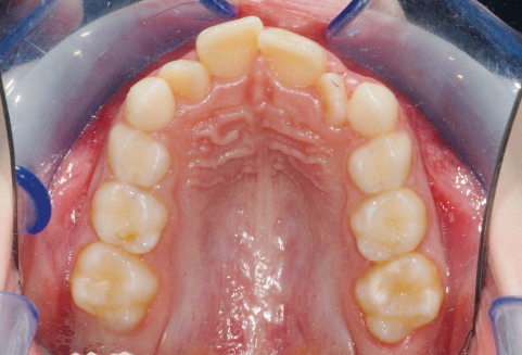 Fig. 2c Fotografia intraorale iniziale del secondo paziente.