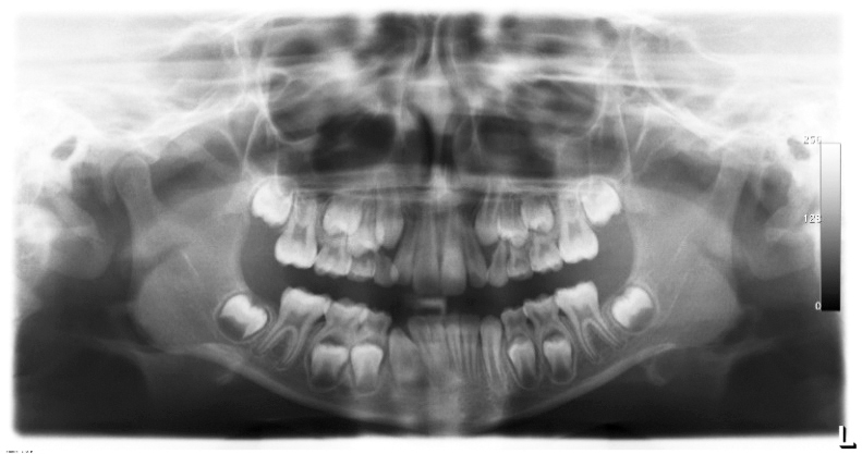 Fig. 3a OPT del primo paziente.