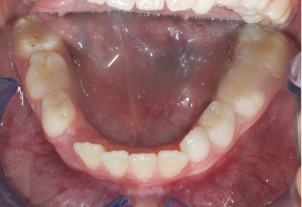 Fig. 6d Disgiuntore del secondo paziente.