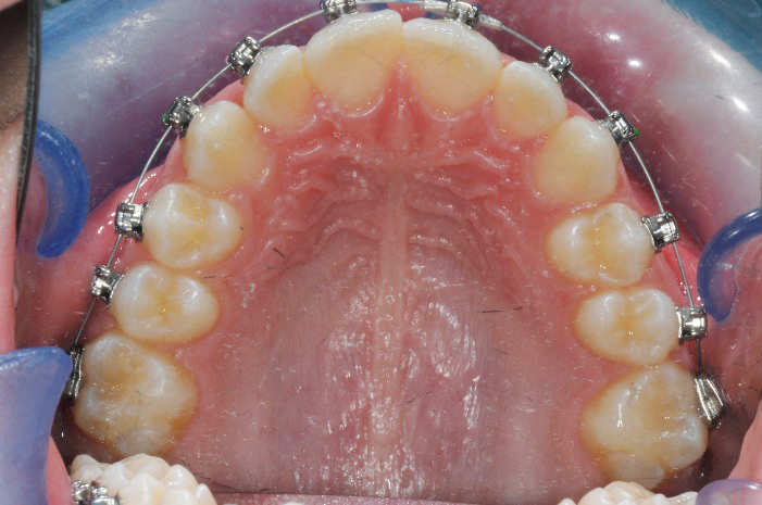 Fig. 7c Fase iniziale del trattamento ortodontico fisso del primo paziente.