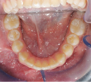 Fig. 7d Fase iniziale del trattamento ortodontico fisso del primo paziente.