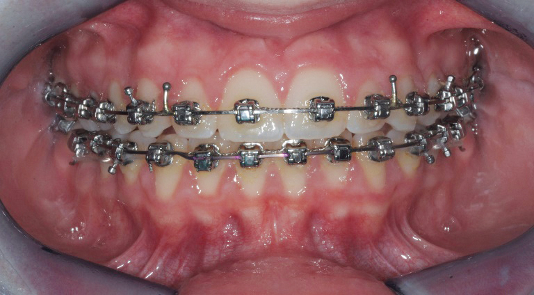 Fig. 7g Fase iniziale del trattamento ortodontico fisso del primo paziente.