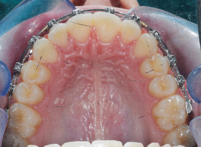 Fig. 7i Fase iniziale del trattamento ortodontico fisso del primo paziente.