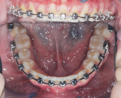 Fig. 7l Fase iniziale del trattamento ortodontico fisso del primo paziente.