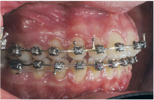 Fig. 7m Fase iniziale del trattamento ortodontico fisso del primo paziente.