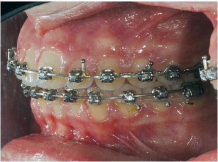 Fig. 7n Fase iniziale del trattamento ortodontico fisso del primo paziente.