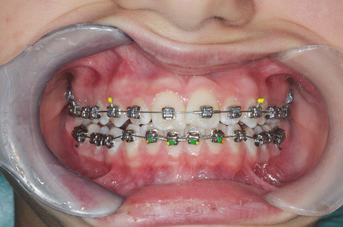 Fig. 8a Fase iniziale del trattamento ortodontico fisso del secondo paziente.