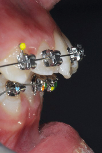 Fig. 8b Fase iniziale del trattamento ortodontico fisso del secondo paziente.