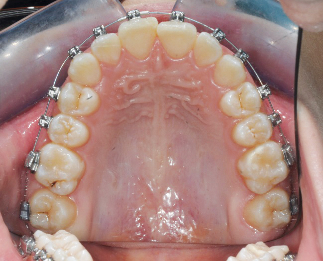 Fig. 8c Fase iniziale del trattamento ortodontico fisso del secondo paziente.