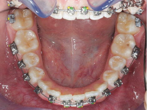 Fig. 8d Fase iniziale del trattamento ortodontico fisso del secondo paziente.