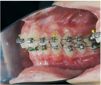 Fig. 8f Fase iniziale del trattamento ortodontico fisso del secondo paziente.