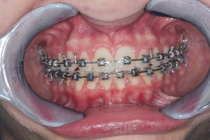 Fig. 9a Fase finale del trattamento ortodontico fisso del primo paziente.