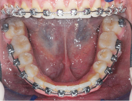 Fig. 9d Fase finale del trattamento ortodontico fisso del primo paziente.