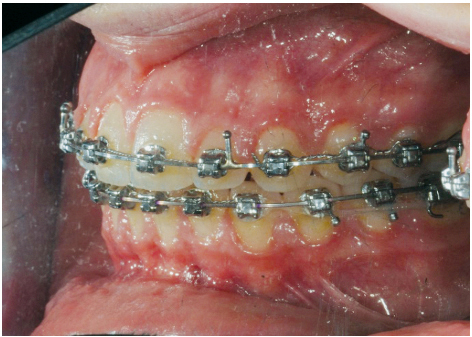 Fig. 9f Fase finale del trattamento ortodontico fisso del primo paziente.