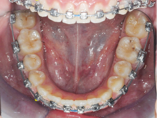 Fig. 10d Fase finale del trattamento ortodontico fisso del secondo paziente.