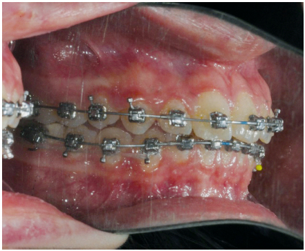 Fig. 10e Fase finale del trattamento ortodontico fisso del secondo paziente.