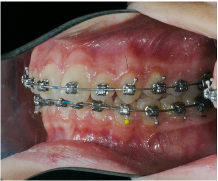 Fig. 10f Fase finale del trattamento ortodontico fisso del secondo paziente.