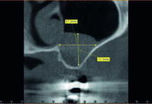 Fig. 1b CBCT del secondo quadrante in cui è possibile osservare la posizione e la dimensione della patologia sinusale: visione sagittale.