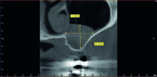 Fig. 1b CBCT del secondo quadrante in cui è possibile osservare la posizione e la dimensione della patologia sinusale: visione sagittale.