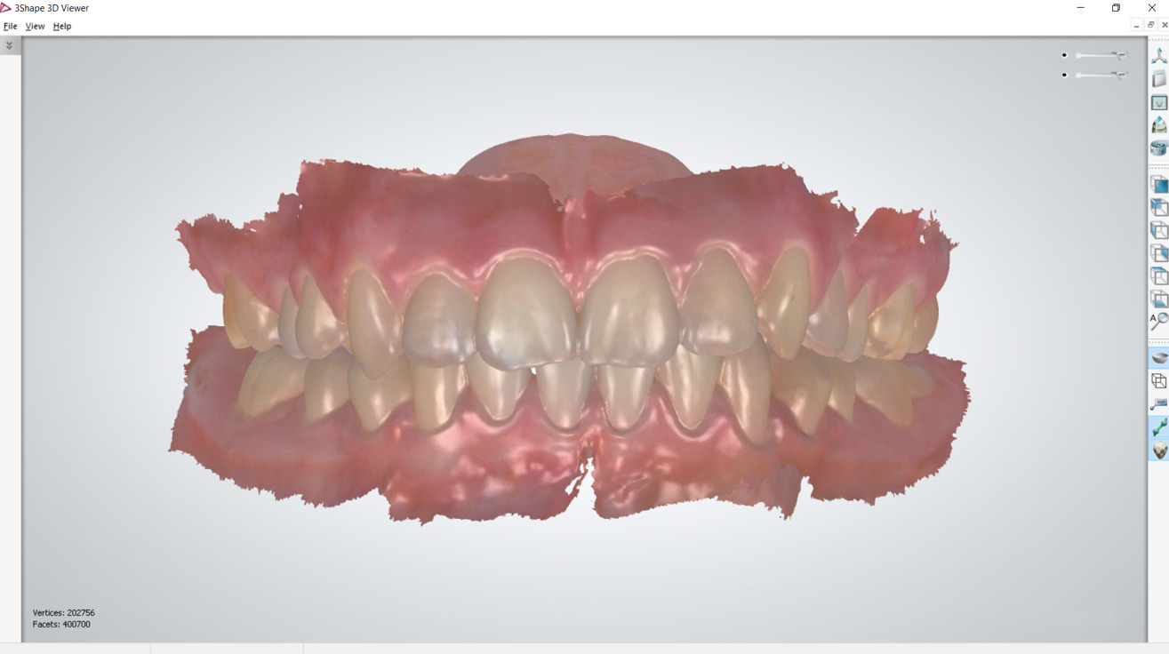 Fig. 2b Scansione intraorale inziale