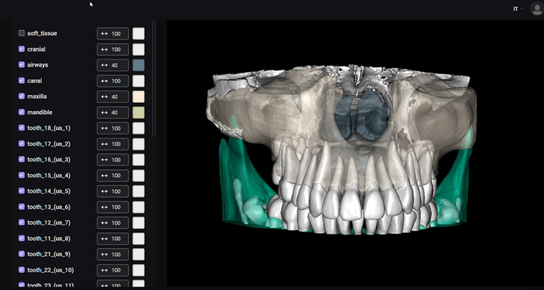 Fig. 5 Segmentazione e conversione file .dicom in files .stl.