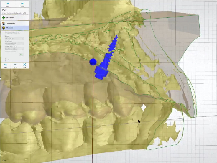 Fig. 6a Progettazione digitale inserimento TADs.