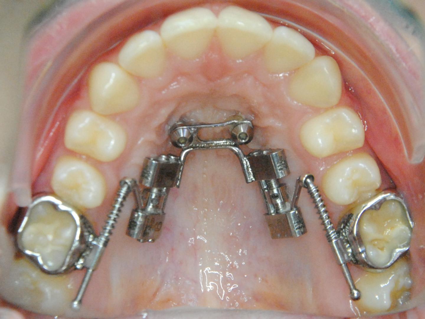 Fig. 15 Post distalizzazione.